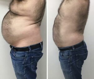 Emagrecimento-Antes-e-Depois